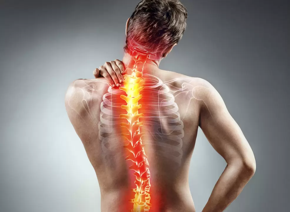 stuburo osteochondrozė